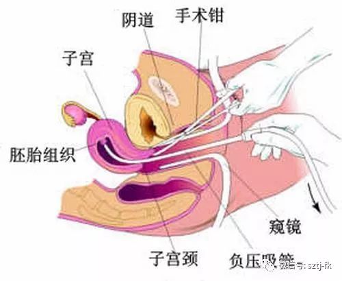 全面解析，6个月引产手术过程